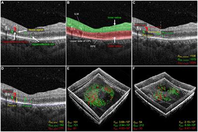 Automated evaluation of retinal hyperreflective foci changes in diabetic macular edema patients before and after intravitreal injection